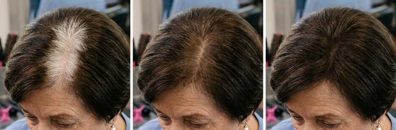 The same part on Dolores: a white stripe on day 14, partly covered after the first application, dark brown with no line after the third